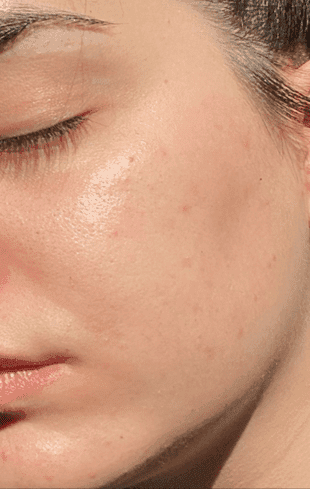 Close-up view of human cheek skin with visible redness and uneven texture indicative of barrier damage.